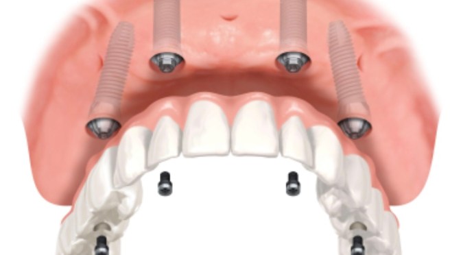 How much? Dental Implants