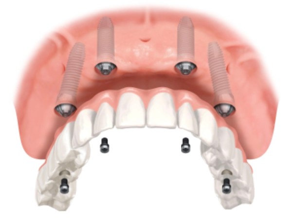 How much? Dental Implants